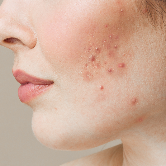 Your Ultimate Self-Care Guide for Acne-Prone Skin